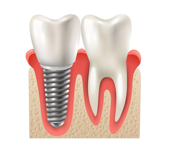 Best Root Canal Treatment in Gamdevi, Mumbai